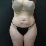 Liposuction Before & After Patient #2033