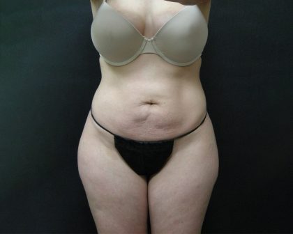 Liposuction Before & After Patient #2033