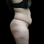 Liposuction Before & After Patient #2033
