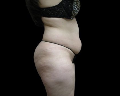 Liposuction Before & After Patient #2033