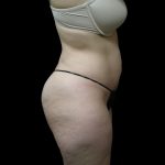 Liposuction Before & After Patient #2033
