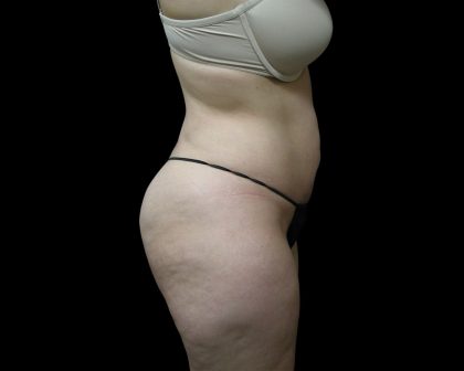 Liposuction Before & After Patient #2033