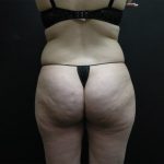 Liposuction Before & After Patient #2033