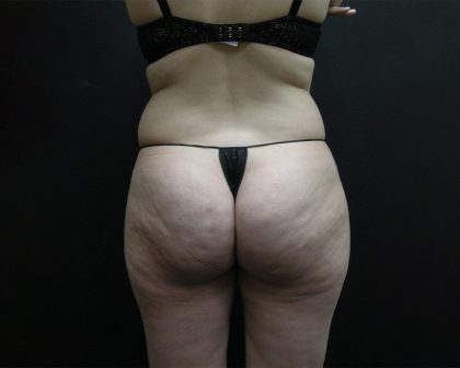 Liposuction Before & After Patient #2033