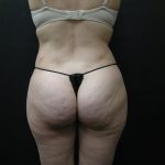 Liposuction Before & After Patient #2033