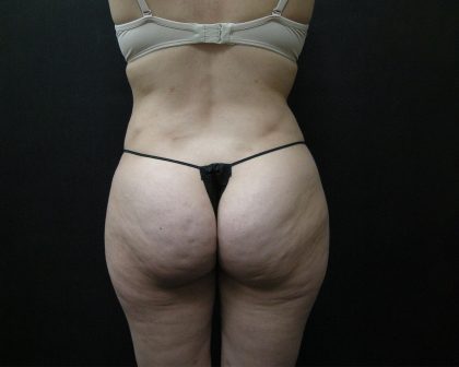 Liposuction Before & After Patient #2033