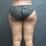 Liposuction Before & After Patient #2076