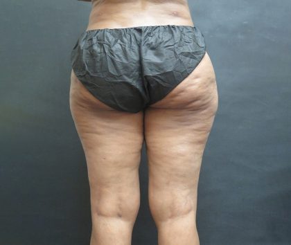 Liposuction Before & After Patient #2076