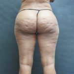 Liposuction Before & After Patient #2076