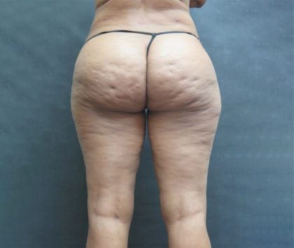 Liposuction Before & After Patient #2076
