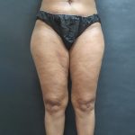 Liposuction Before & After Patient #2076