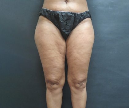Liposuction Before & After Patient #2076