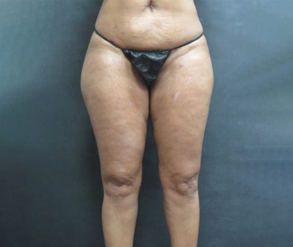 Liposuction Before & After Patient #2076