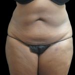 Liposuction Before & After Patient #2095