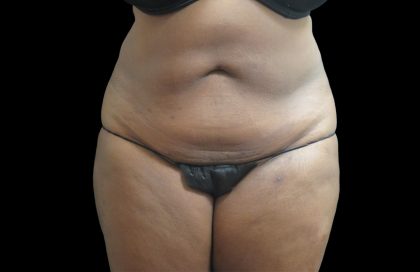 Liposuction Before & After Patient #2095