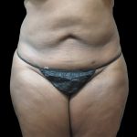 Liposuction Before & After Patient #2095