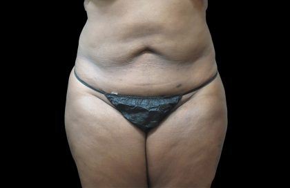 Liposuction Before & After Patient #2095
