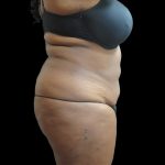 Liposuction Before & After Patient #2095