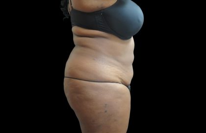 Liposuction Before & After Patient #2095