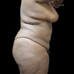 Liposuction Before & After Patient #2095