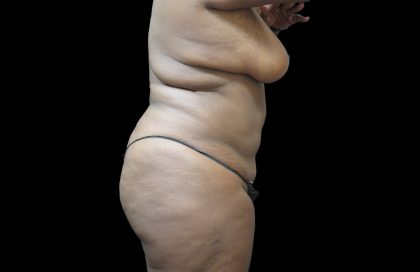 Liposuction Before & After Patient #2095