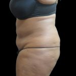 Liposuction Before & After Patient #2095