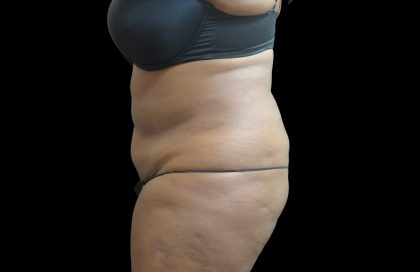 Liposuction Before & After Patient #2095