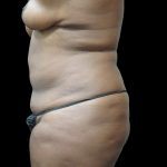 Liposuction Before & After Patient #2095