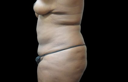Liposuction Before & After Patient #2095