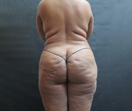 Liposuction Before & After Patient #2111