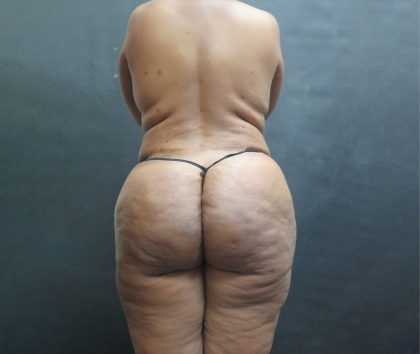 Liposuction Before & After Patient #2111
