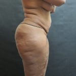 Liposuction Before & After Patient #2111