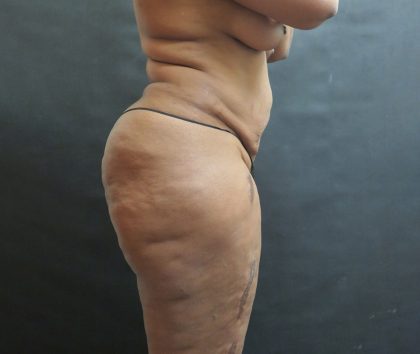 Liposuction Before & After Patient #2111