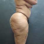 Liposuction Before & After Patient #2111