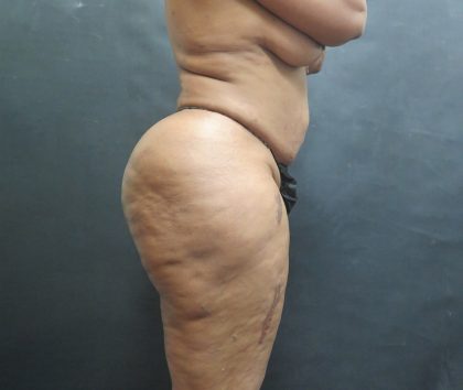Liposuction Before & After Patient #2111