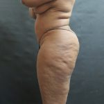 Liposuction Before & After Patient #2111