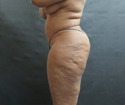 Liposuction Before & After Patient #2111