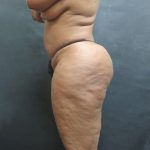 Liposuction Before & After Patient #2111