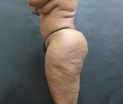 Liposuction Before & After Patient #2111