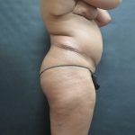 Liposuction Before & After Patient #2118