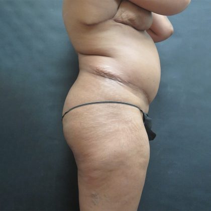 Liposuction Before & After Patient #2118