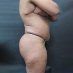 Liposuction Before & After Patient #2118