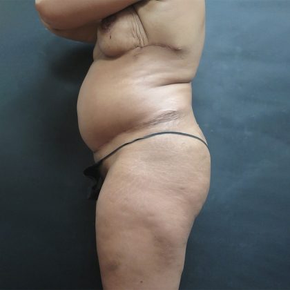 Liposuction Before & After Patient #2118