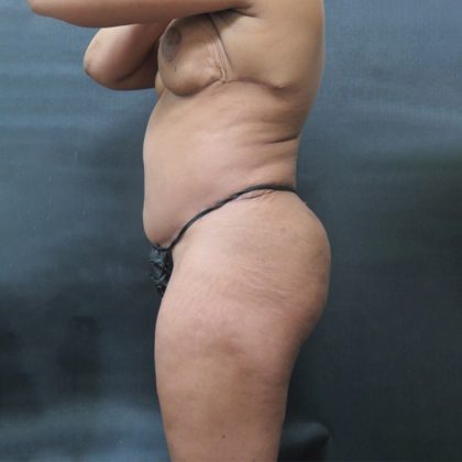 Liposuction Before & After Patient #2118