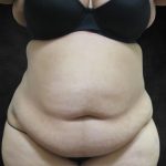 Liposuction Before & After Patient #2123