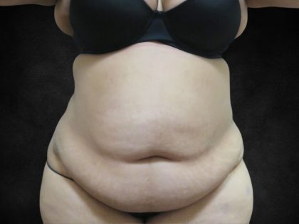 Liposuction Before & After Patient #2123