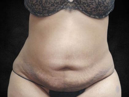 Liposuction Before & After Patient #2123