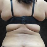 Liposuction Before & After Patient #2123