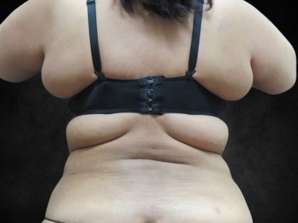 Liposuction Before & After Patient #2123