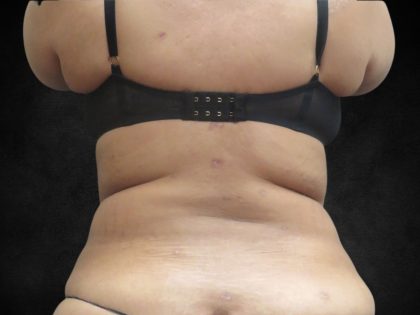 Liposuction Before & After Patient #2123